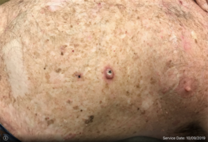 Squamous Cell Carcinoma