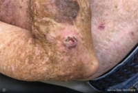 Squamous Cell Carcinoma