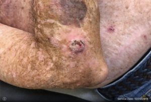 Squamous Cell Carcinoma