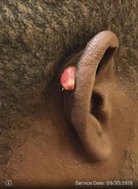 Ear Surgery