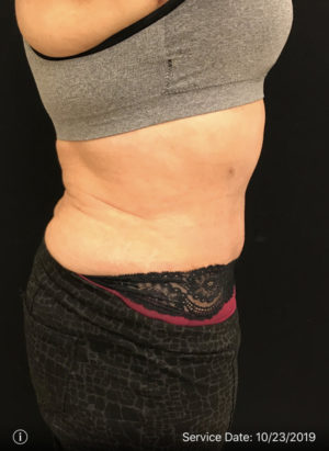 Tummy Tuck