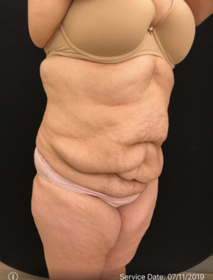 Tummy Tuck