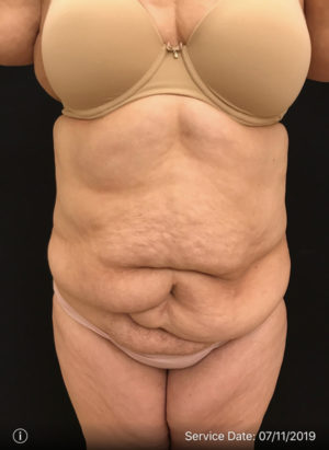 Tummy Tuck