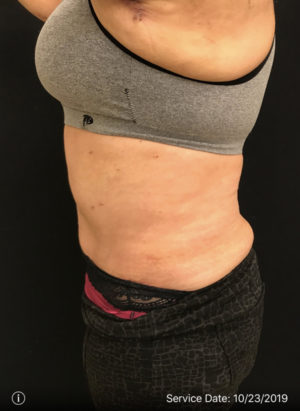 Tummy Tuck