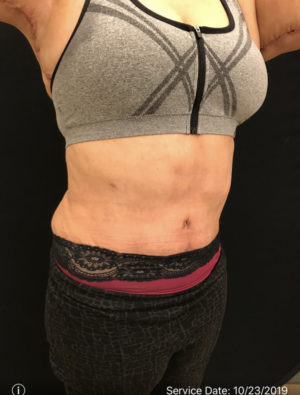 Tummy Tuck