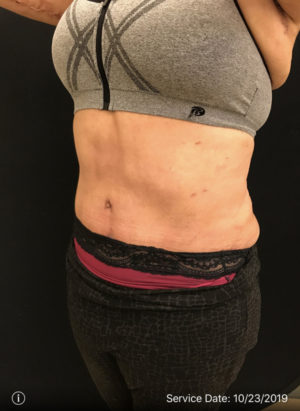 Tummy Tuck