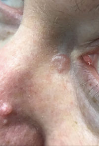 Basal Cell Carcinoma