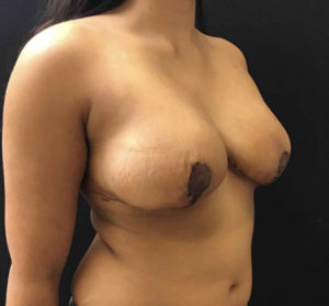 Breast Reduction