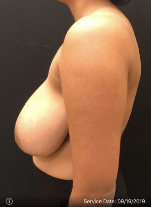 Breast Reduction
