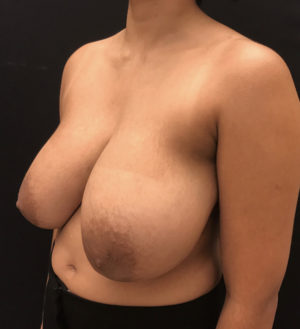 Breast Reduction