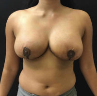 Breast Reduction