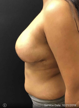 Breast Reduction