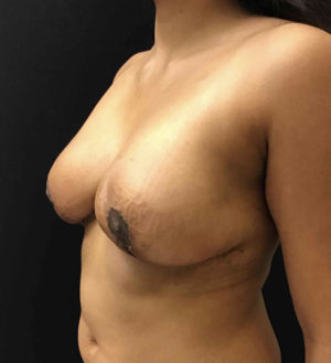 Breast Reduction
