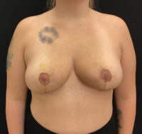 Breast Reduction