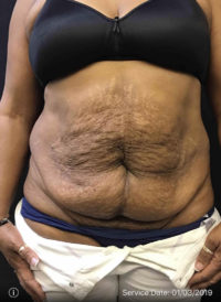 Tummy Tuck