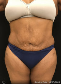 Tummy Tuck