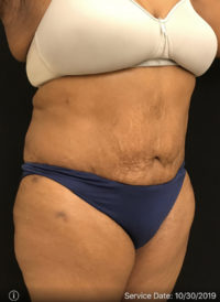 Tummy Tuck