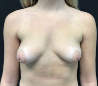 Breast Augmentation