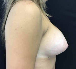 Breast Augmentation