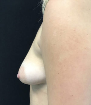 Breast Augmentation