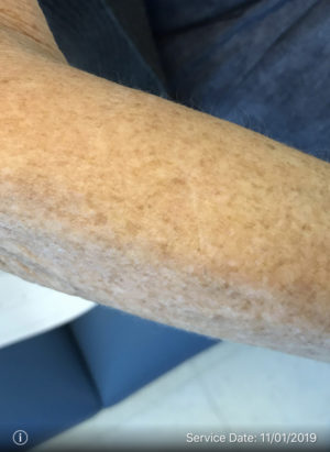 Squamous Cell Carcinoma