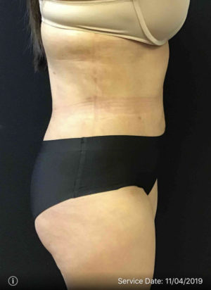 Tummy Tuck