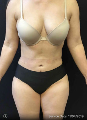 Tummy Tuck