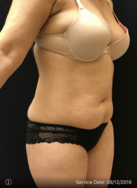 Tummy Tuck