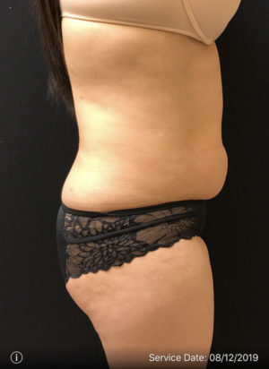 Tummy Tuck