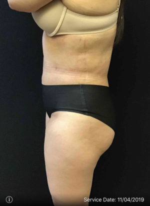 Tummy Tuck