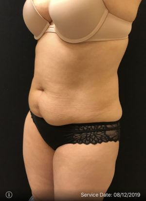 Tummy Tuck