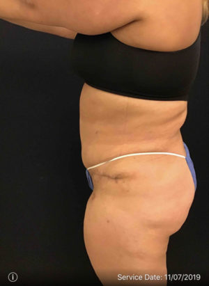 Tummy Tuck