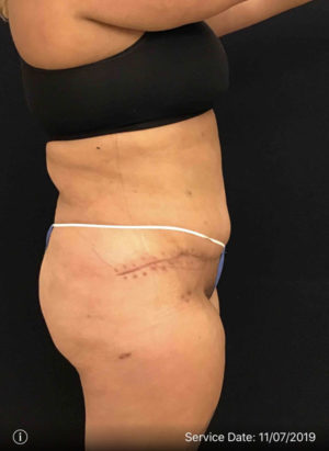 Tummy Tuck