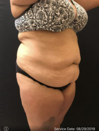 Tummy Tuck