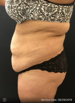 Tummy Tuck
