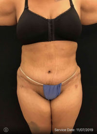 Tummy Tuck