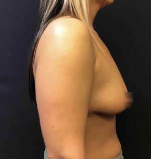 Breast Augmentation