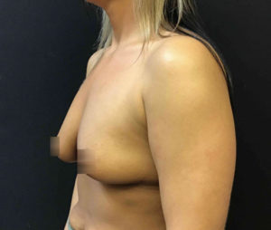 Breast Augmentation