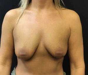 Breast Augmentation