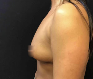 Breast Augmentation