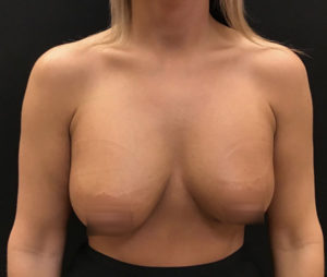 Breast Augmentation