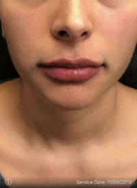 Lip Augmentation