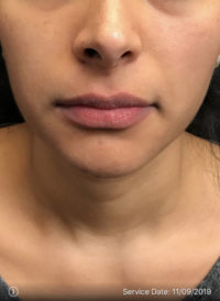 Lip Augmentation