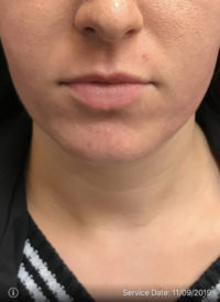 Lip Augmentation