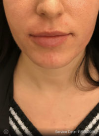 Lip Augmentation