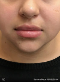 Lip Augmentation