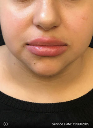 Lip Augmentation