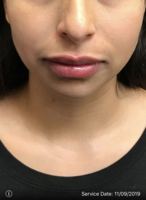 Lip Augmentation