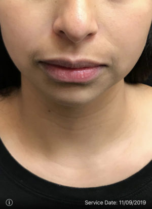 Lip Augmentation