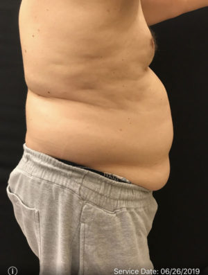 Liposuction